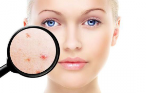 Steeds meer volwassenen met acne