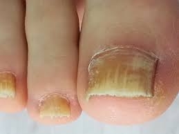 Schimmelnagels... die wil niemand.